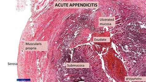 Acute Appendicitis Pathology Made Simple