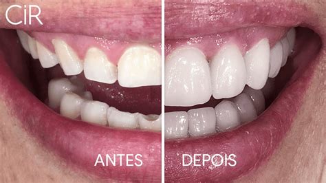 Antes E Depois Do Cir Lentes De Contato Dental Facetas De Porcelana