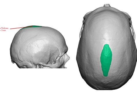 Plastic Surgery Case Study Sagittal Skull Reshaping With Sagittal