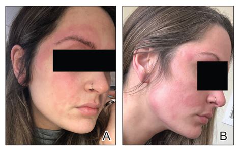 Dupilumab Induced Facial Flushing After Alcohol Consumption Mdedge Dermatology