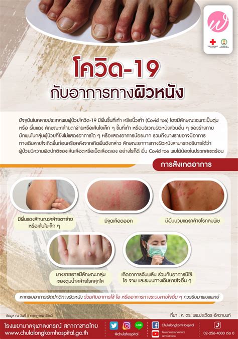 โควิด 19 กับอาการทางผิวหนัง โรงพยาบาลจุฬาลงกรณ์ สภากาชาดไทย