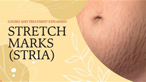 Stretch Marks Stria Causes And Treatment Explained Stratum Distensae Youtube