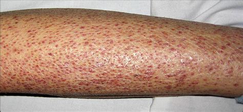 Purpuric Skin Pictures Photos