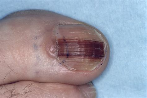 Nail Apparatus Melanoma Features Good Survival And Functional Outcome
