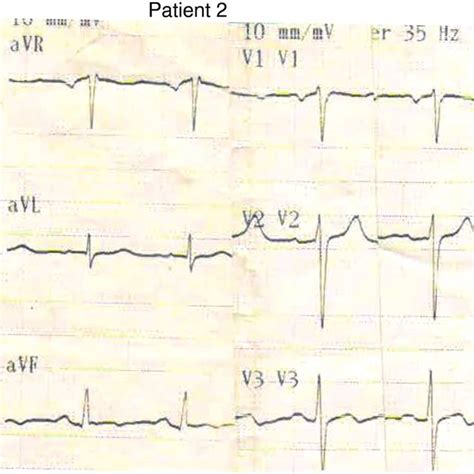 Electrocardiogram Shown St Elevation In Leads Ii Iii And Avf And