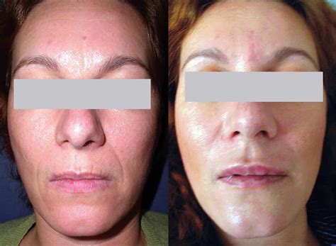 Spectralift Non Surgical Facelift A Facelift Without Surgery