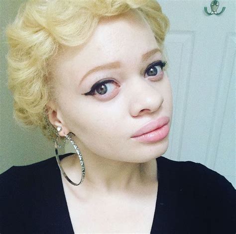 10 Stunning Photos Of Black Albinos From The InMySkinIWin Campaign