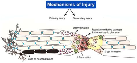 Pathophysiology Of Primary And Secondary Injury During Spinal Cord Injury Download Scientific