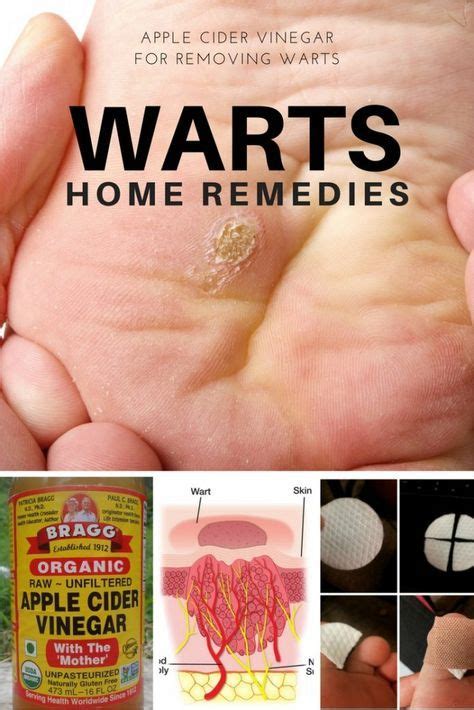 How To Use Apple Cider Vinegar For Warts Apple Cider Vinegar Warts Wart Treatment Get Rid Of
