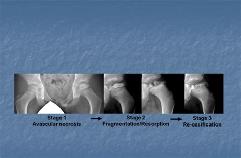 Perthes Disease Stages Legg Calve Perthes Disease Diagnosis Imaging