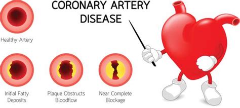 Royalty Free Coronary Artery Clip Art Vector Images And Illustrations