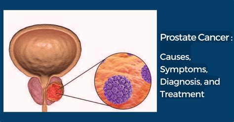 Exploring The Causes Of Prostate Cancer Symptoms Treatment