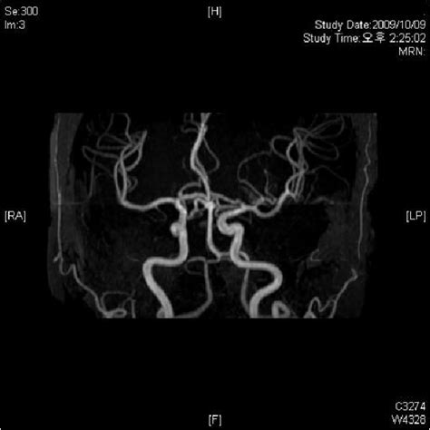 Normal Study Of Mra Angiography Abbreviation Mra Magnetic Resonance