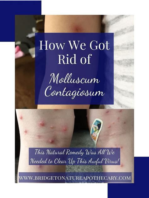 How To Get Rid Of Molluscum Contagiosum In 2020 Natural Remedies