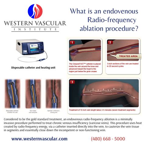 Endovenous Radiofrequency Ablation Or Rfa Procedure Western Vascular