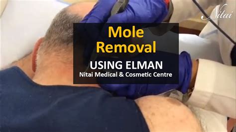 Remove Mole From Back Of Neck Using Ellman Machine Nitai Medical