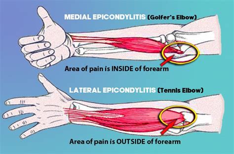 Lateral And Medial Epicondylitis