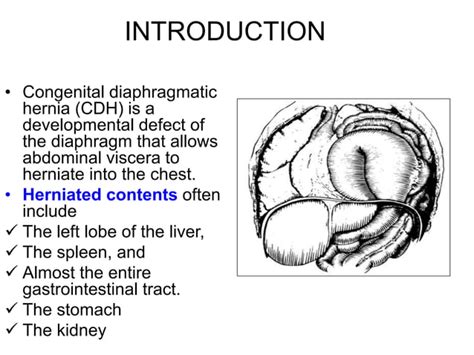 Final Congenital Diaphragmatic Hernia Pptpptx