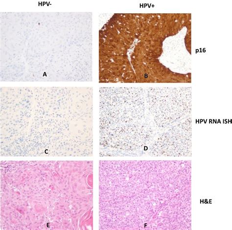 Representative Of Positive And Negative P16 Immunostaining And