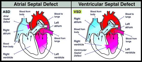 Atrial Septal Defect Vs Ventricular Septal Defect Both Increase