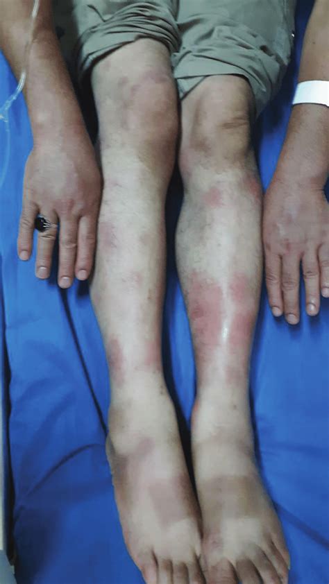 Clinical Image Of Erythema Nodosum On Arms And Legs Download