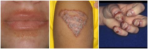 Contact dermatitis is a type of inflammation of the skin. Many substances can cause eczema | MN Spokesman-Recorder