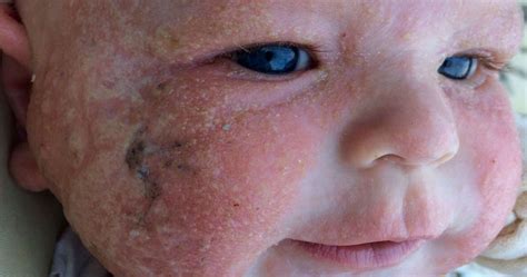 Baby Endures Extreme Eczema While Parents Watch Helplessly