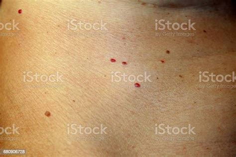 Angioma On The Skin Red Moles On The Body Many Birthmarks Stock Photo