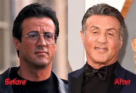 Sylvester Stallone Before And After Cosmetic Procedure Sylvester Stallone