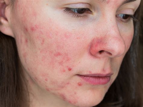 Demodex Mites With T Cell Exhaustion In Rosacea Patients With