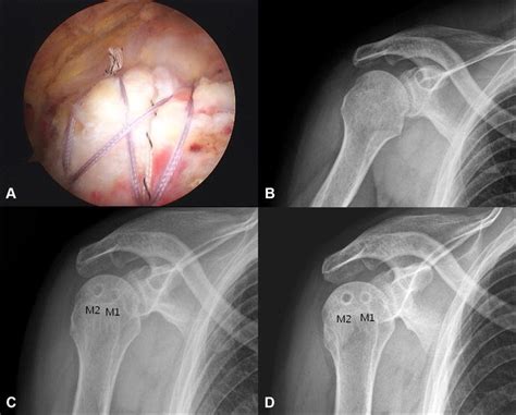 A Large Size Rotator Cuff Tear On The Right Shoulder In A Year Old Download Scientific