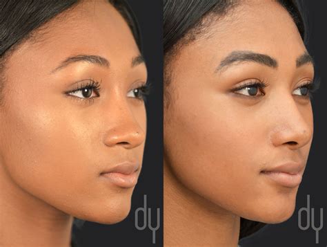 Ethnic Nose Job Before And After Jessenia Cutler