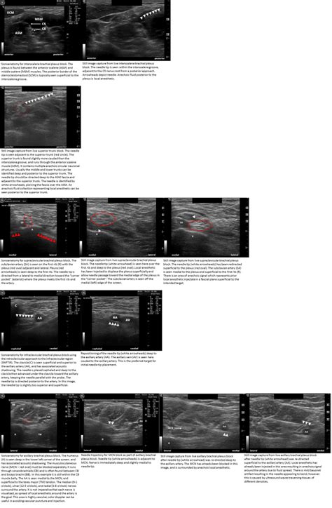 Figure Sonoanatomy And Needle Placement For Statpearls Ncbi