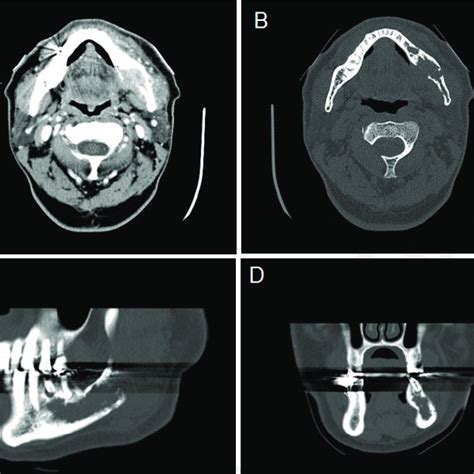 A Contrast Enhanced Axial Computed Tomography Ct Images Showing The