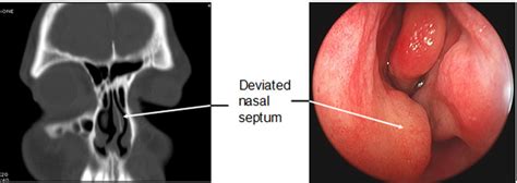 Deviated Septum Causes Symptoms How To Fix A Deviated Septum
