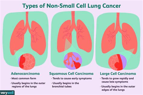 los tipos más comunes de cáncer de pulmón medicina básica
