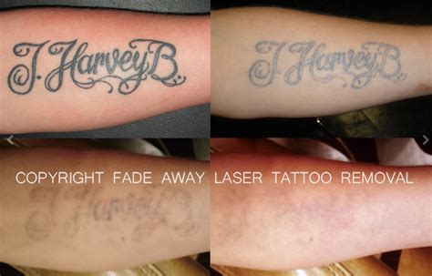 Fade Away Laser Tattoo Removal In Duluth Mn Whitepages