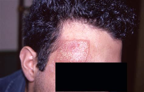 Dermatitis Ekzema Dermatitis Picture Hellenic Dermatological