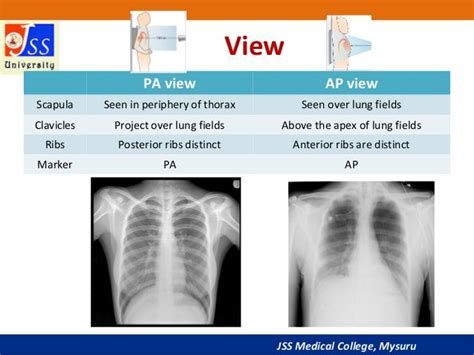Image Result For Ap X Ray View Mysuru Medical College X Ray