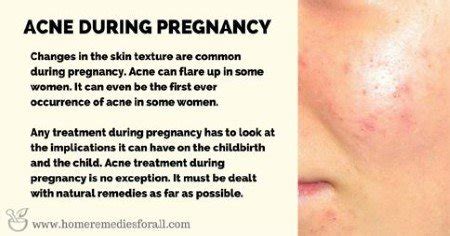 Acne treatments: How to play it safe during pregnancy - TIPS HEALTH