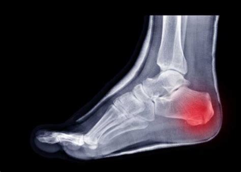 Calcaneal Fracture Broken Heel Bone Plantar Fasciitis Orthopedic Foot And Ankle Specialist