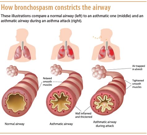 Understanding Asthma Pathophysiology Diagnosis And Management
