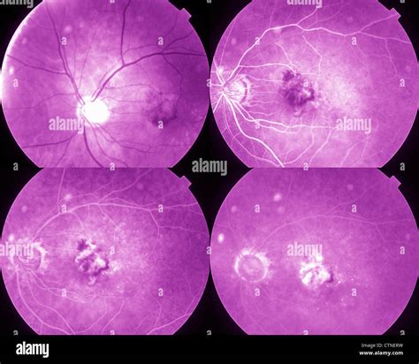 Cuatro Fases Angiografía Del Ojo Mostrando Dmae La Degeneración Macular