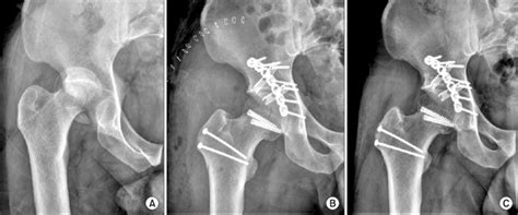 A Preoperative Anteroposterior Pelvic Radiograph Of A 33 Year Old