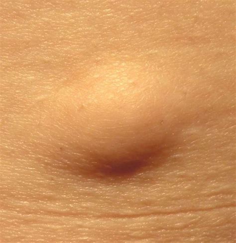 Rib Cage Lipoma This Is How You Can Cure Lipomas Scientific