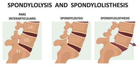 Spondylolysis Recover Physio Hastings
