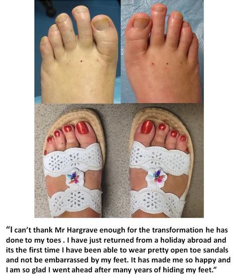 What Is Toe Shortening Surgery Called