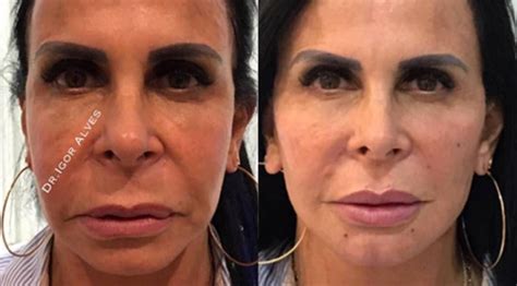 Confira o antes e depois dos famosos que fizeram harmonização facial Diversão O Dia