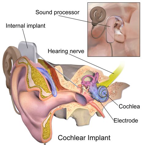 Cochlear Implants Introduction To Sensation And Perception
