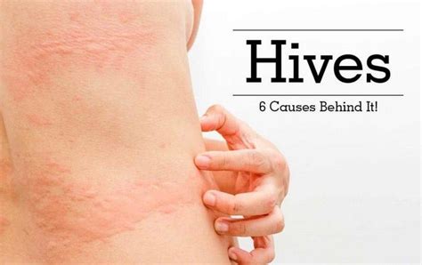 5 Effective Home Remedies For Hives Urticaria Hives Urticaria